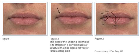 Fuller Lips in an Instant: The Lip Lock Spell Revealed